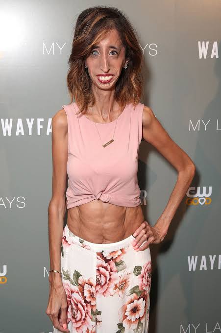 Lizzie Velasquez skinny condition

Skinniest people in the world