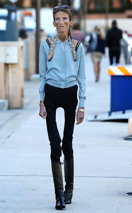 Valeria Levitin skinniest person in the world