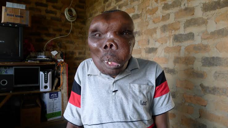 Godfrey Baguma Biography: Ugliest Man in the World, Age, Third Wife, Wikipedia, Disease, Children & Net Worth